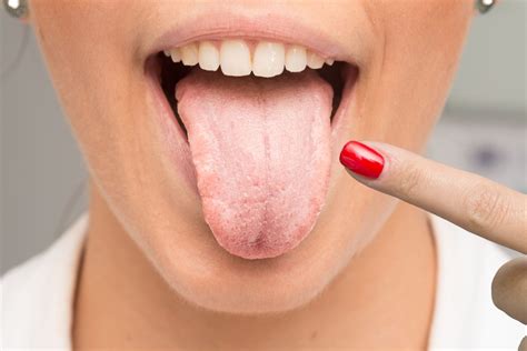 Oral Thrush: Symptoms, Causes, Treatments | Pacific Cross Vietnam