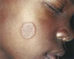 Ringworm African American