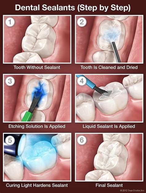 Seal Out Tooth Decay – Dr. Idelle Brand – Medium | Dental sealants, Dental hygiene school ...