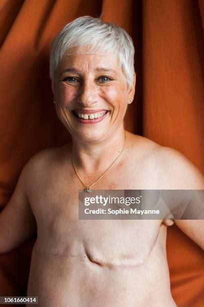 64 Mastectomy Scar Stock Photos, High-Res Pictures, and Images - Getty Images