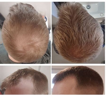 Finasteride Results: Timeline, Photos, Before & After