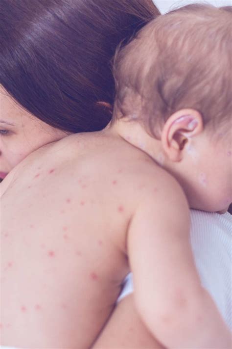 Chickenpox in babies: Pictures, symptoms, and treatments