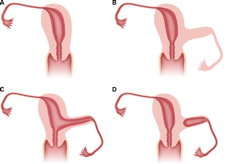 Schematic drawings of unicornuate uterus subtypes. Unicornuate uterus... | Download Scientific ...