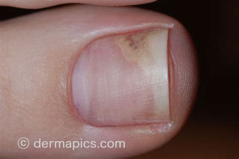 Nail Fungal Infection Causes And Treatment - Nail Ftempo