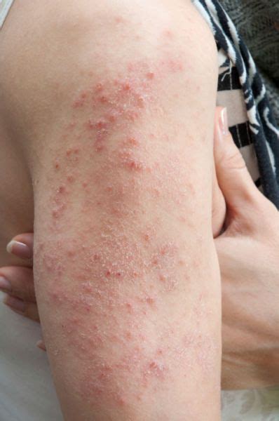 What is Dermatitis Herpetiformis | Food allergy rash, Allergies