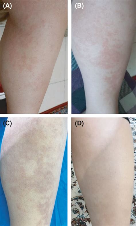 (A, B) Erythematous plaques on both extremities on the second day of... | Download Scientific ...