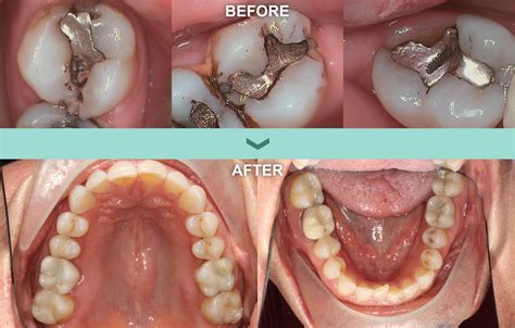 SMART certified in the removal of amalgam fillings | Boise Dentist