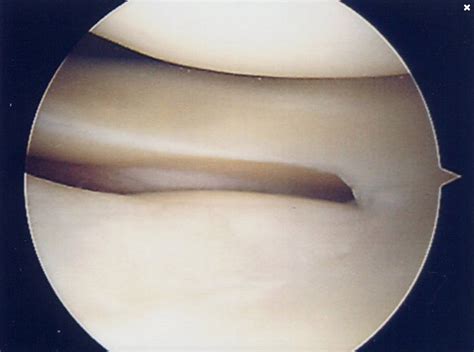 Knee Arthroscopy — Amir Qureshi Orthopaedic Surgeon | Knee Surgeon Southampton