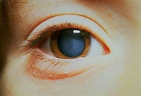 Gonorrhea Eye Treatment