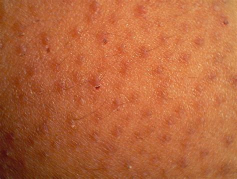 Skin Bumps Keratosis