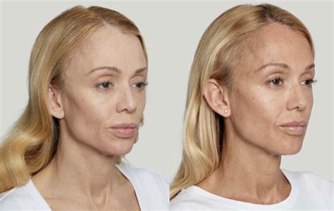 Sculptra Before & After Case 01 | Boston Medical Aesthetics