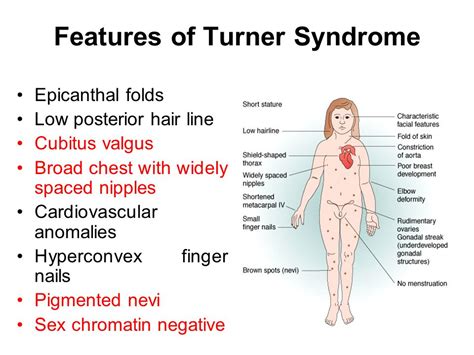 Turner Syndrome Diagnosis and Treatment | Faculty of Medicine