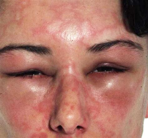 Angioedema causes, symptoms, diagnosis and angioedema treatment