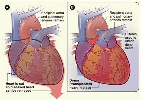 Medical Treatment Pictures-for Better Understanding: Heart Transplant Surgery: Before & After ...