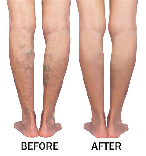 Varicose Veins Before & After - Cardiovascular Labs of America