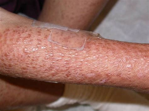 Skin Diseases Caused By Virus