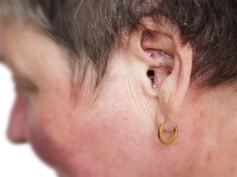 Can You Cure Aural Dermatitis/Ear Eczema? | Balmonds