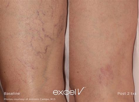 Excel V Laser Vascular Lesion Treatment Beverly Hills | Los Angeles CA