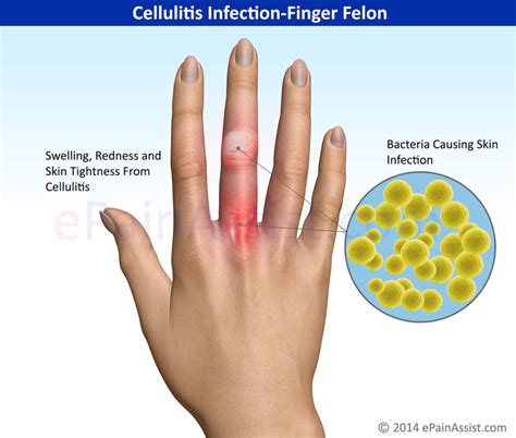 Cellulitis Skin Infection Symptoms | What is Cellulitis? | Synergy ...