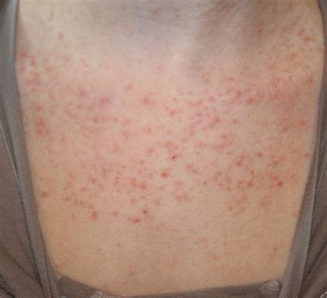 Top 105+ Pictures Keratosis Pilaris Amlactin Before And After Pictures Stunning