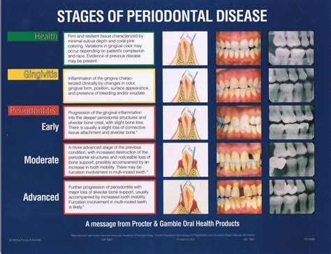 Periodontal Disease And How it Affects Your Health - VVNG