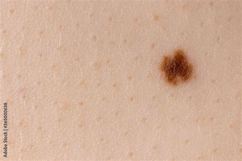 What are Moles How They Formed? Types and Prevention of Moles