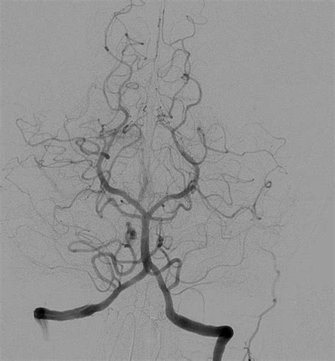 Cerebral angiography - Wikipedia