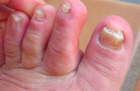 Toenail Fungus: Causes, Treatments, Symptoms, and More