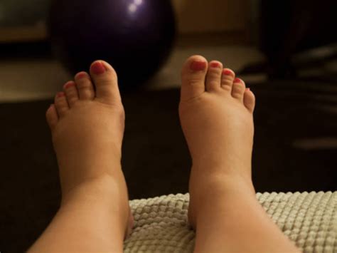 swollen feet during pregnancy called edema causes and treatment