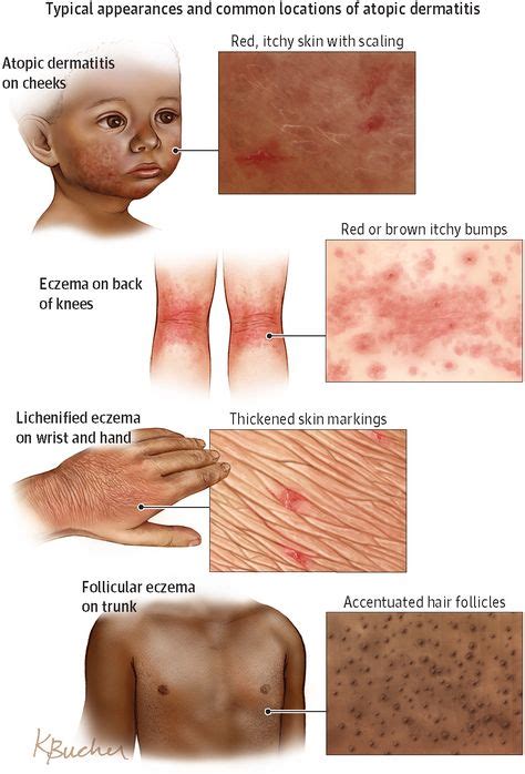 Atopic Dermatitis | Atopic dermatitis, Dermatology nurse, Dermatology