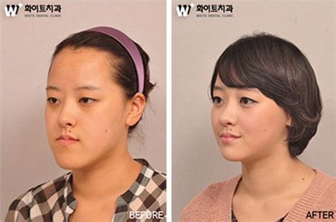 31 Crazy Before And After Photos Of Korean Plastic Surgery | Korean ...