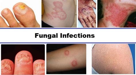 Fungal Infections: Causes, Symptoms and Treatment - Helal Medical