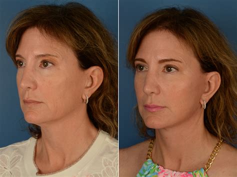 Lower Facelift Vs Neck Lift What S The Difference Nec - vrogue.co