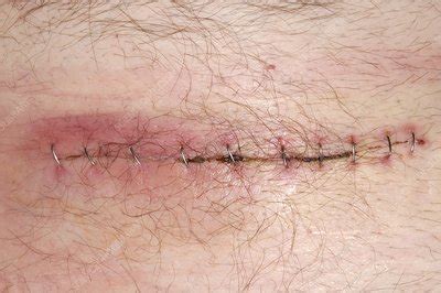 Infected appendix surgery wound - Stock Image - C002/4728 - Science Photo Library