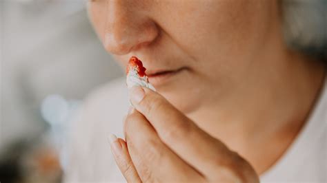 Nosebleed Causes: Everything You Should Know - GoodRx