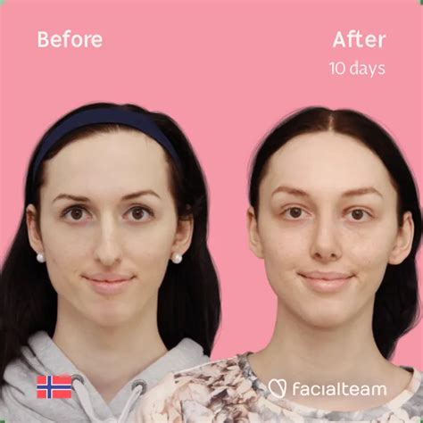 Before And After Facial Feminization Surgery — Facialteam