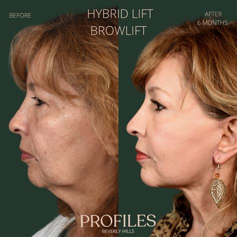 Best Facelift Surgeon Los Angeles | Facelift Beverly Hills