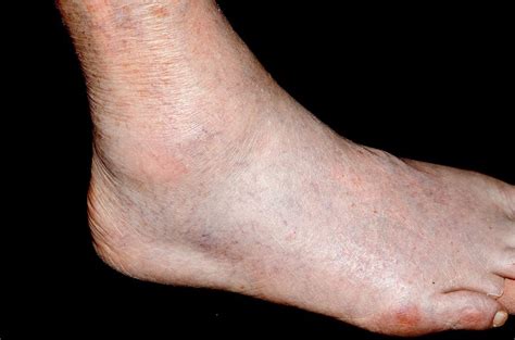 Gout In The Ankle Photograph by Dr P. Marazzi/science Photo Library