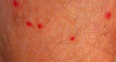 What Causes Small Red Itchy Bumps On Skin