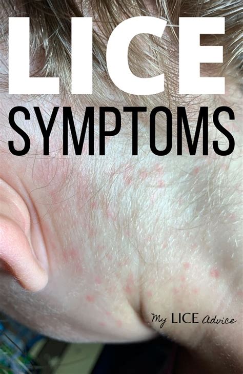 17 Lice Symptoms with Pictures: Signs That You Have Head Lice in 2020 ...