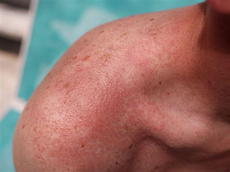 How Do Heat Rashes Look Like: Identifying Common Symptoms