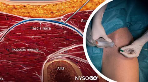 Fascia Iliaca Block - NYSORA e-Learning System