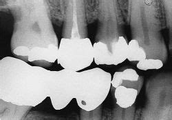 bitewing radiography - meddic