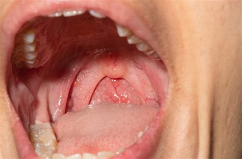 Cobblestone Throat: Symptoms, Pictures & Treatment