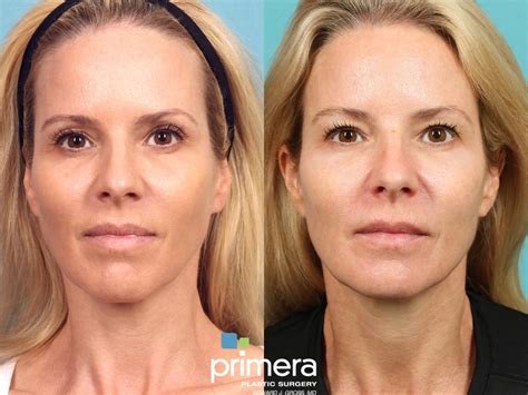 Sculptra® Before and After Pictures Case 906 | Orlando, Florida ...