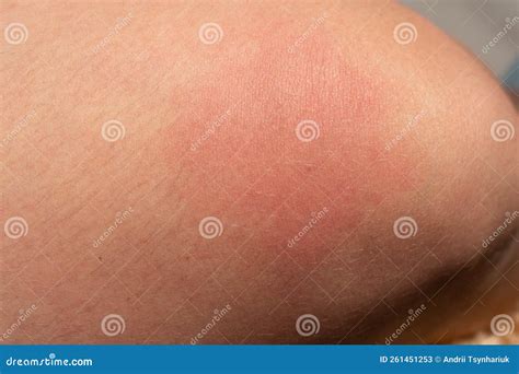 Bee Sting. Bee Sting In Human Skin. Consequences Of Stinging With Bee Venom Stock Photo ...