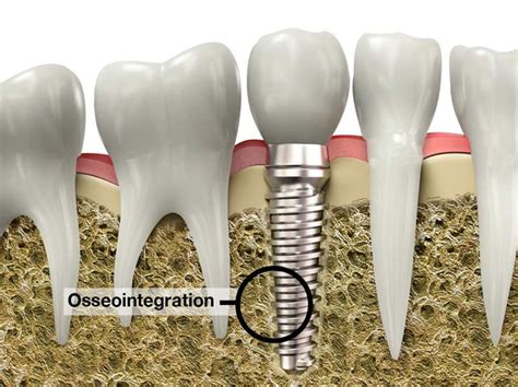 Osseointegration