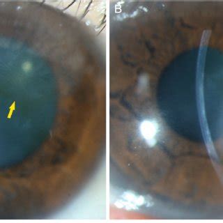 Stocker's line (slit-lamp photo). (A) A 64-year-old male diagnosed with ...