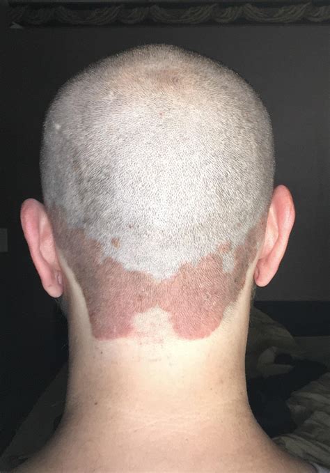 I knew something was going on back there since starting lithium for bipolar. Shaved my head to ...