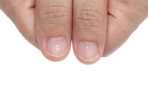 This change in your fingernails could be a sign of lung cancer
